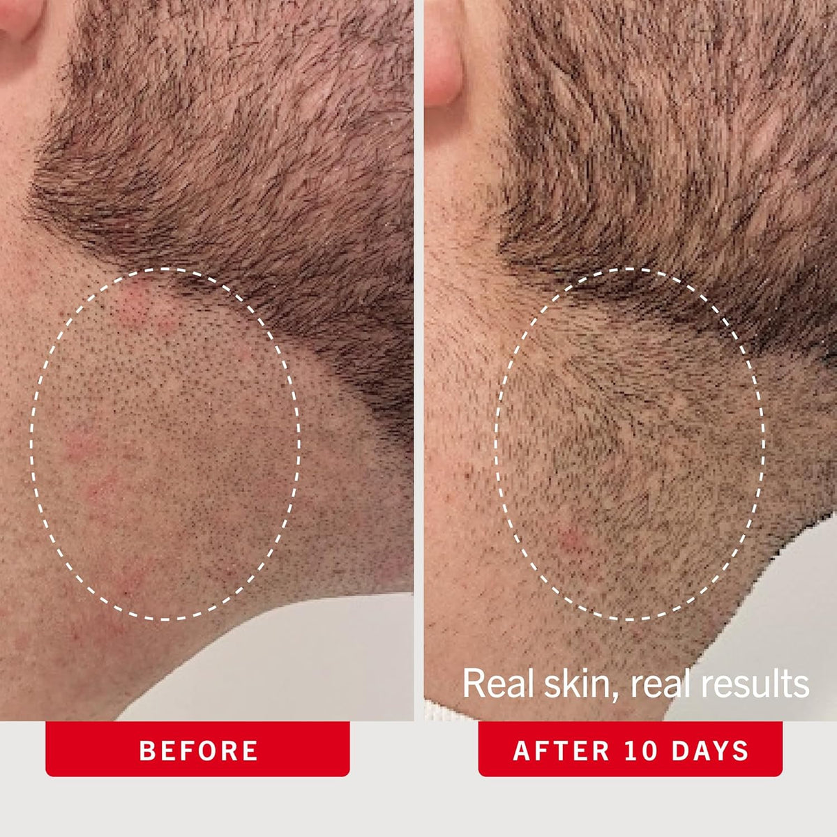 First Aid Beauty Ingrown Hair Pads with BHA and AHA